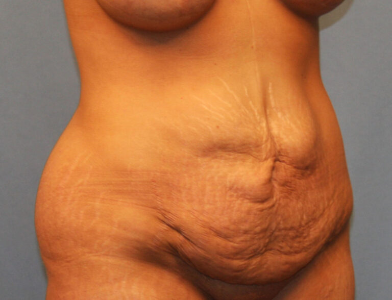 Before Image: Tummy Tuck - right-front-oblique