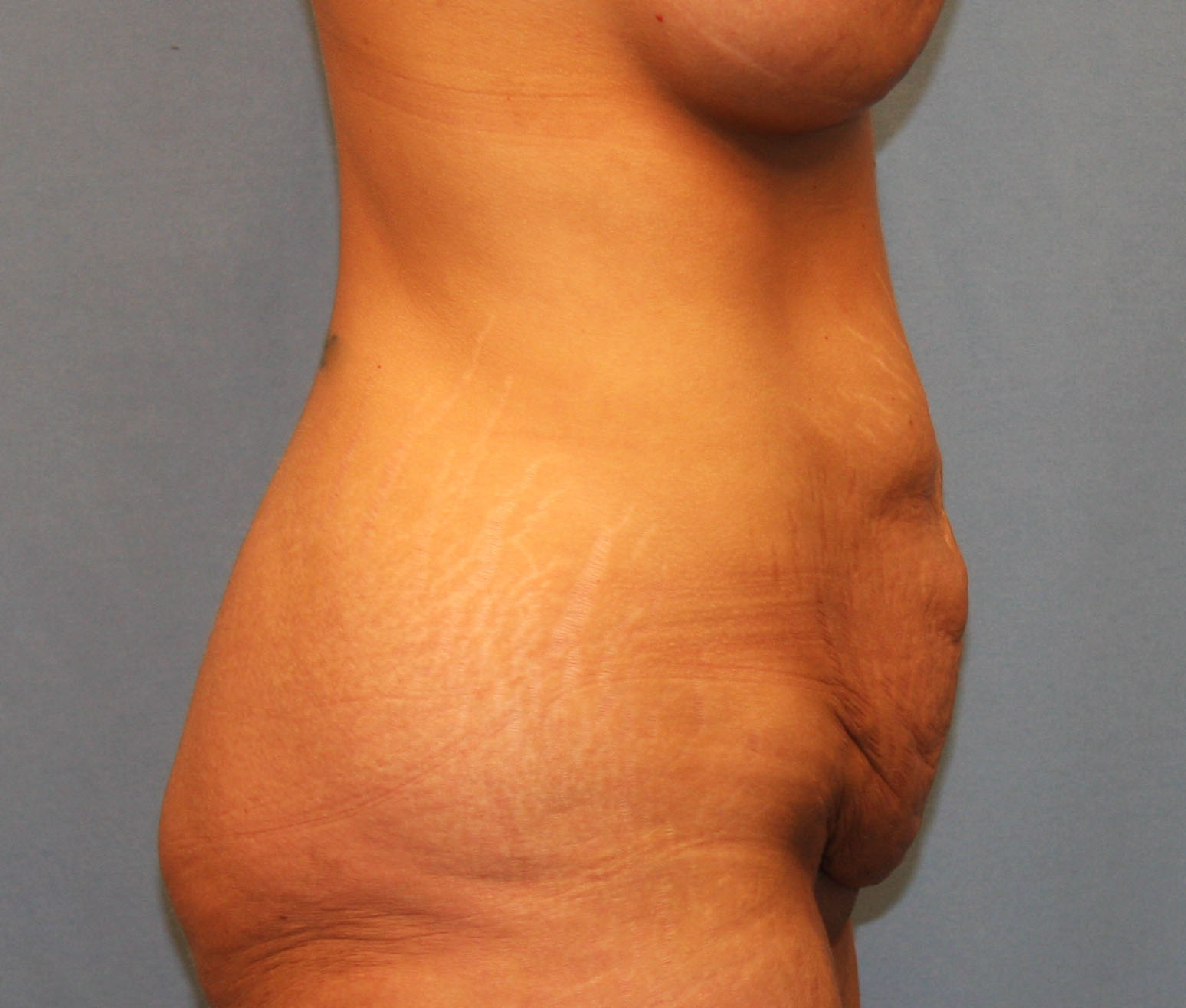 Before Image: Tummy Tuck - right-side
