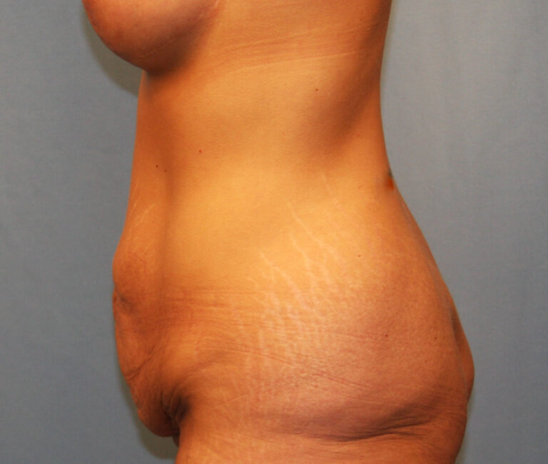 Before Image: Tummy Tuck - left-side