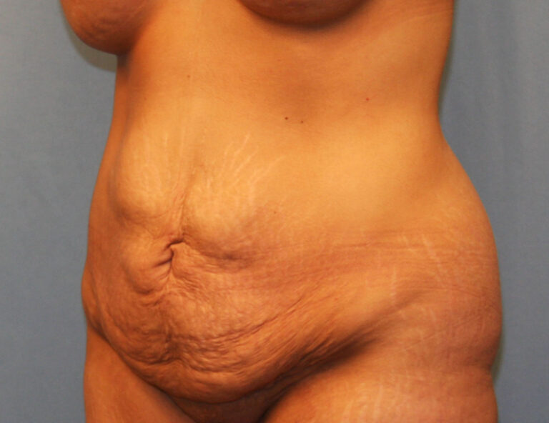 Before Image: Tummy Tuck - left-front-oblique