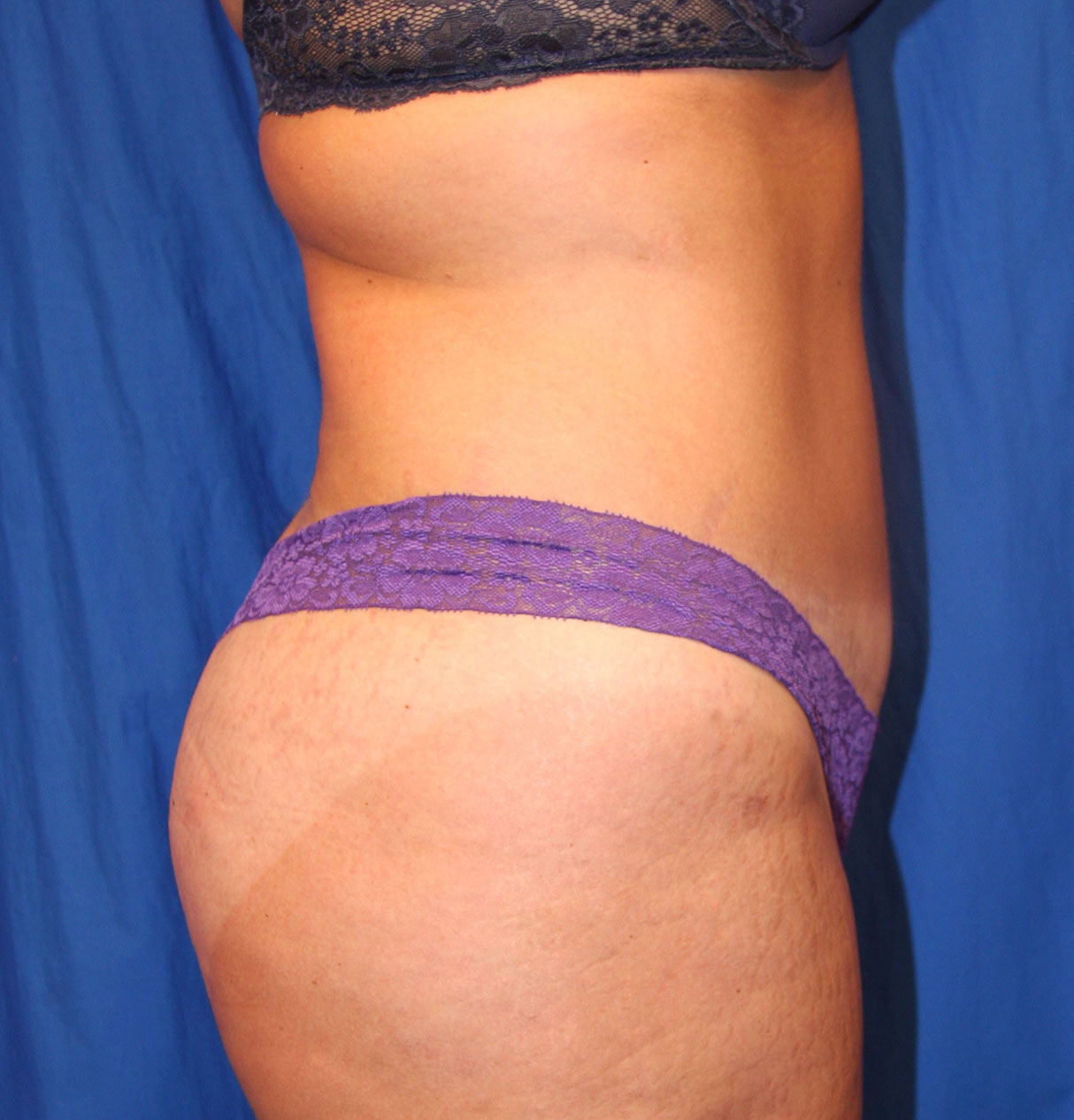 After Image: Tummy Tuck - right-side