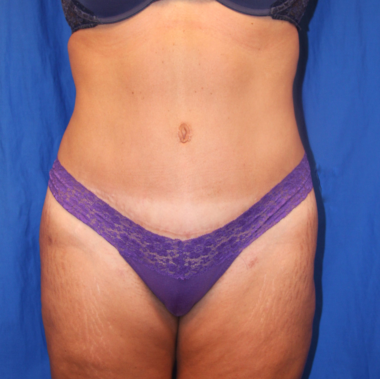 After Image: Tummy Tuck - front