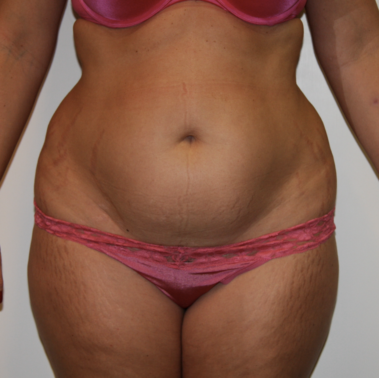 Before Image: Tummy Tuck - front