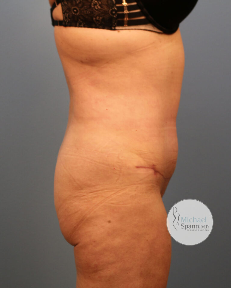 After Image: Tummy Tuck - right-side