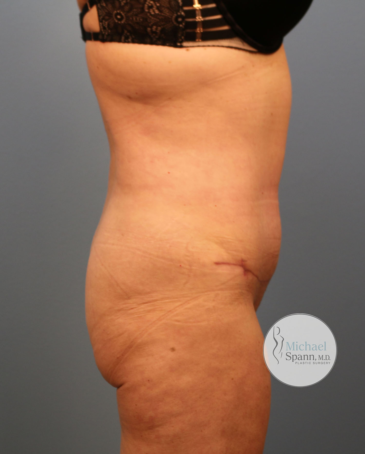 After Image: Tummy Tuck - right-side