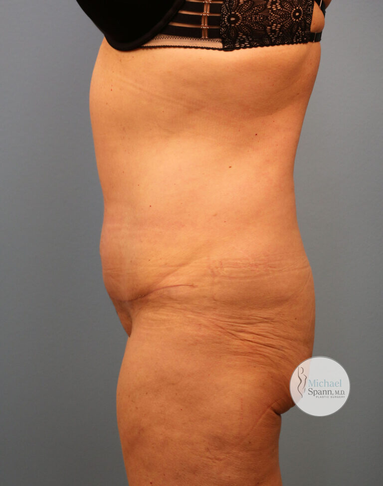 After Image: Tummy Tuck - left-side