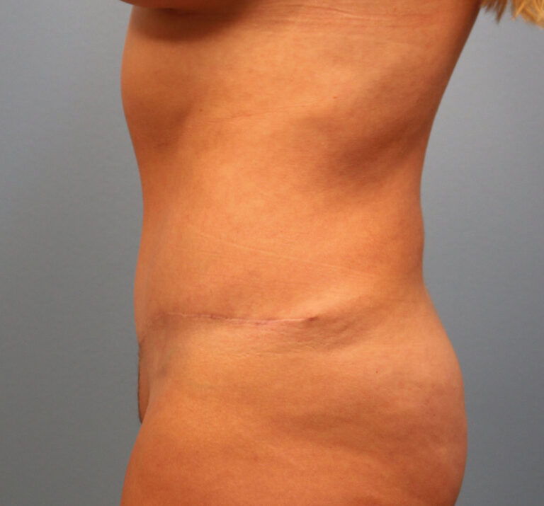 After Image: Tummy Tuck - left-side