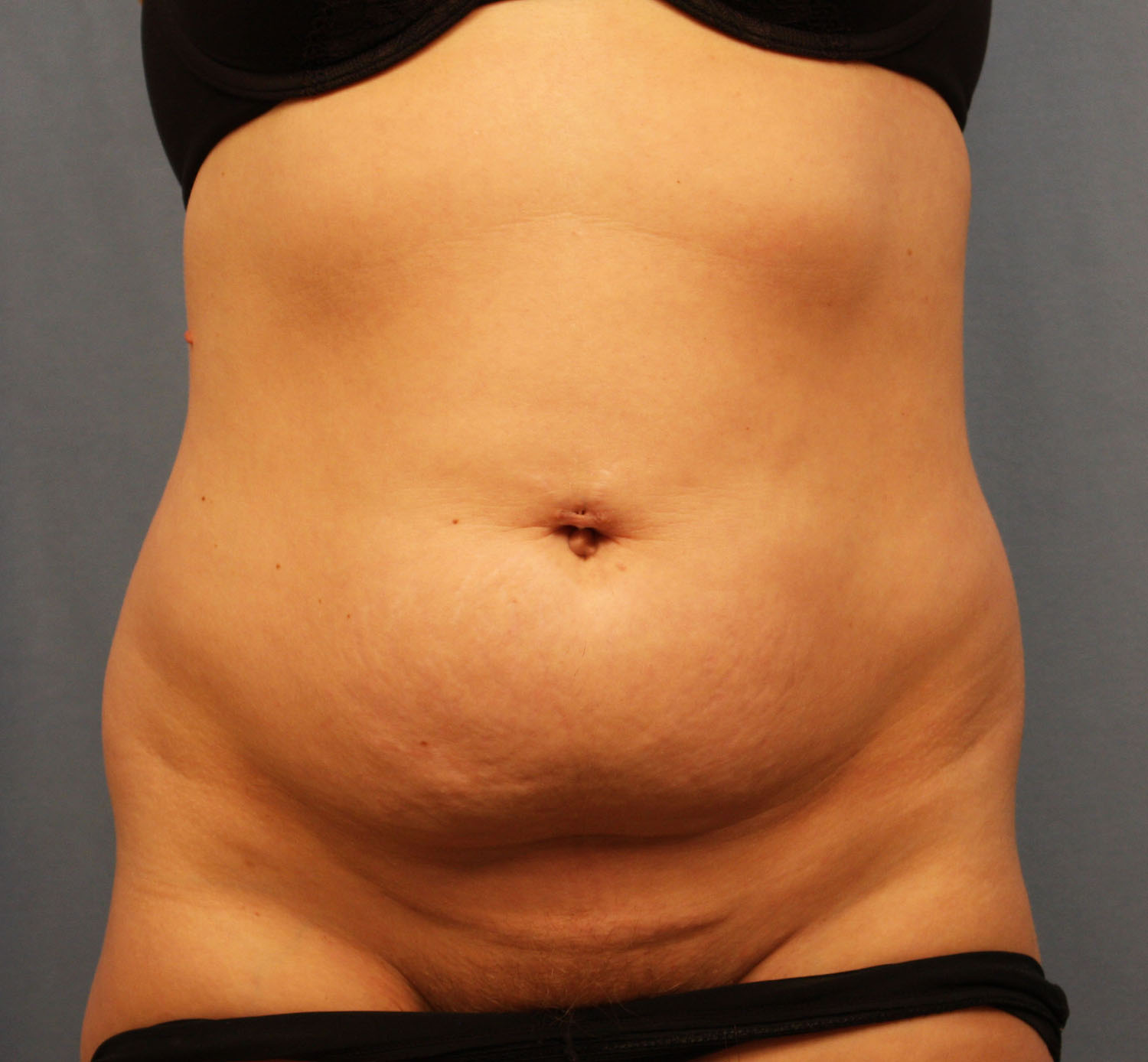 Before Image: Tummy Tuck - front