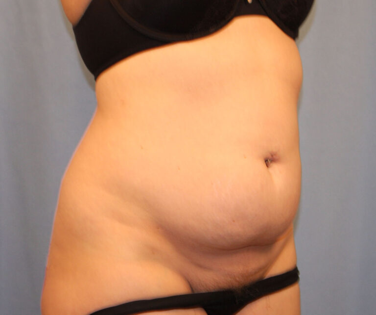 Before Image: Tummy Tuck - right-front-oblique