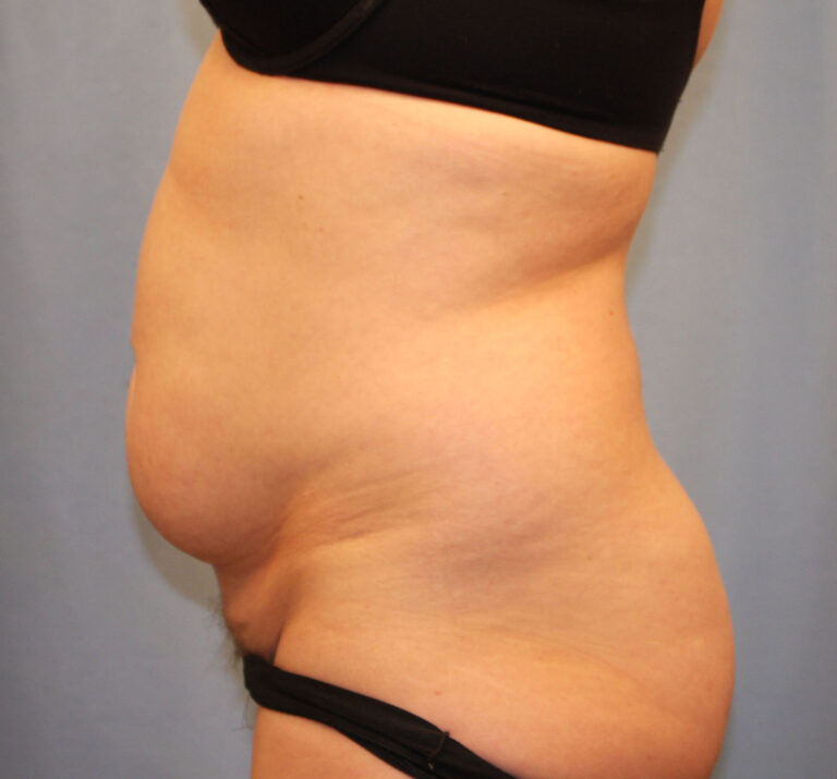 Before Image: Tummy Tuck - left-side