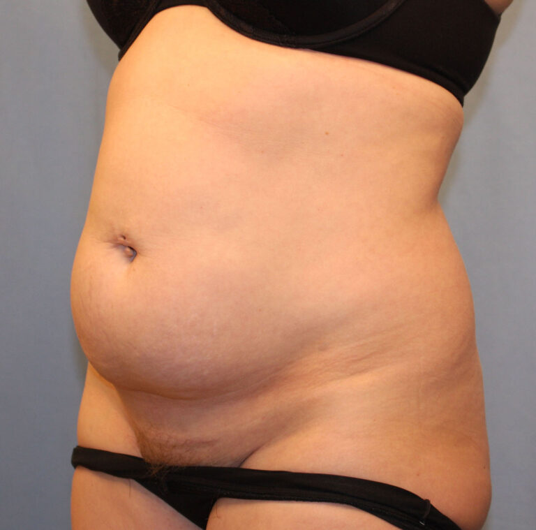 Before Image: Tummy Tuck - left-front-oblique