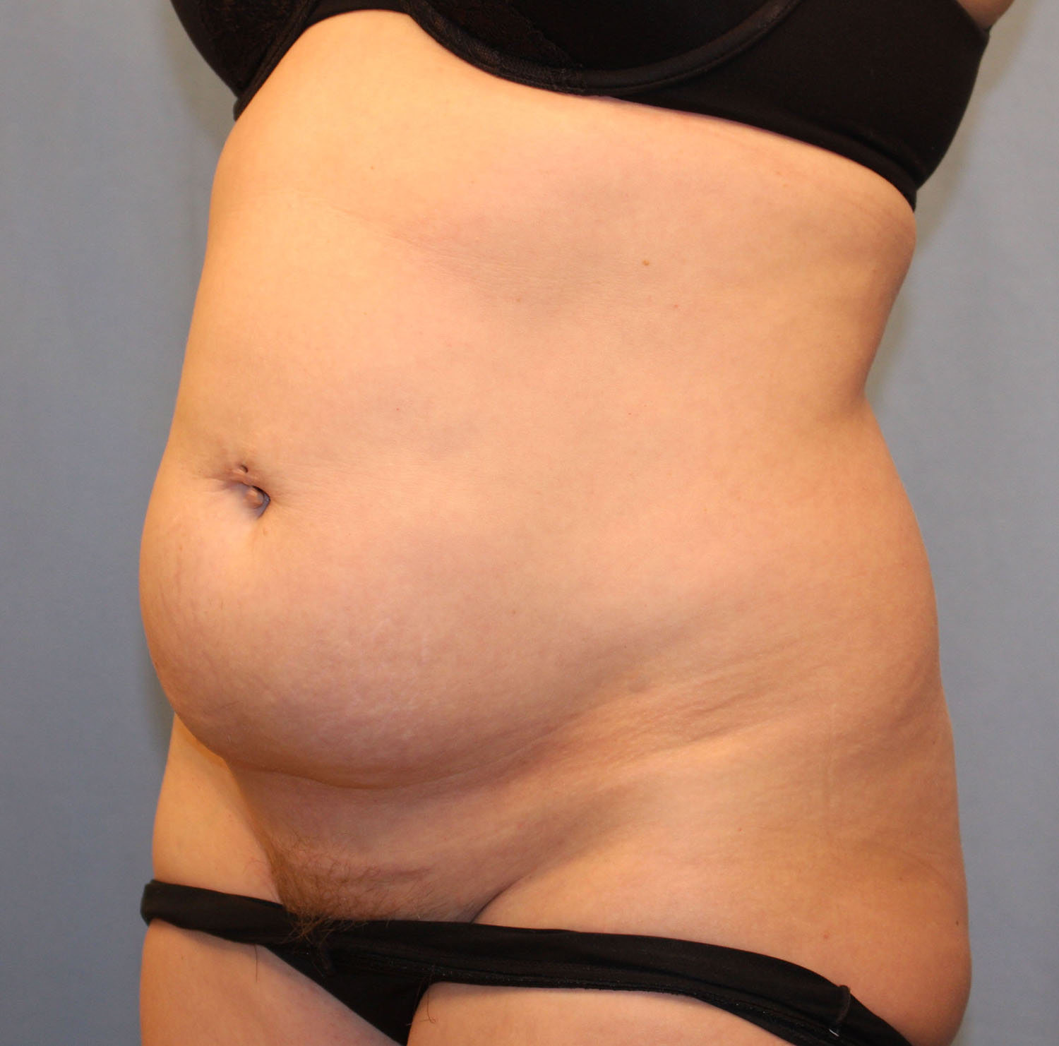 Before Image: Tummy Tuck - left-front-oblique