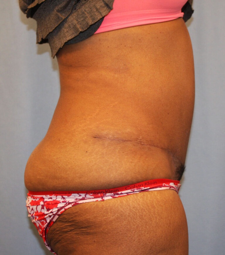 After Image: Tummy Tuck - right-side