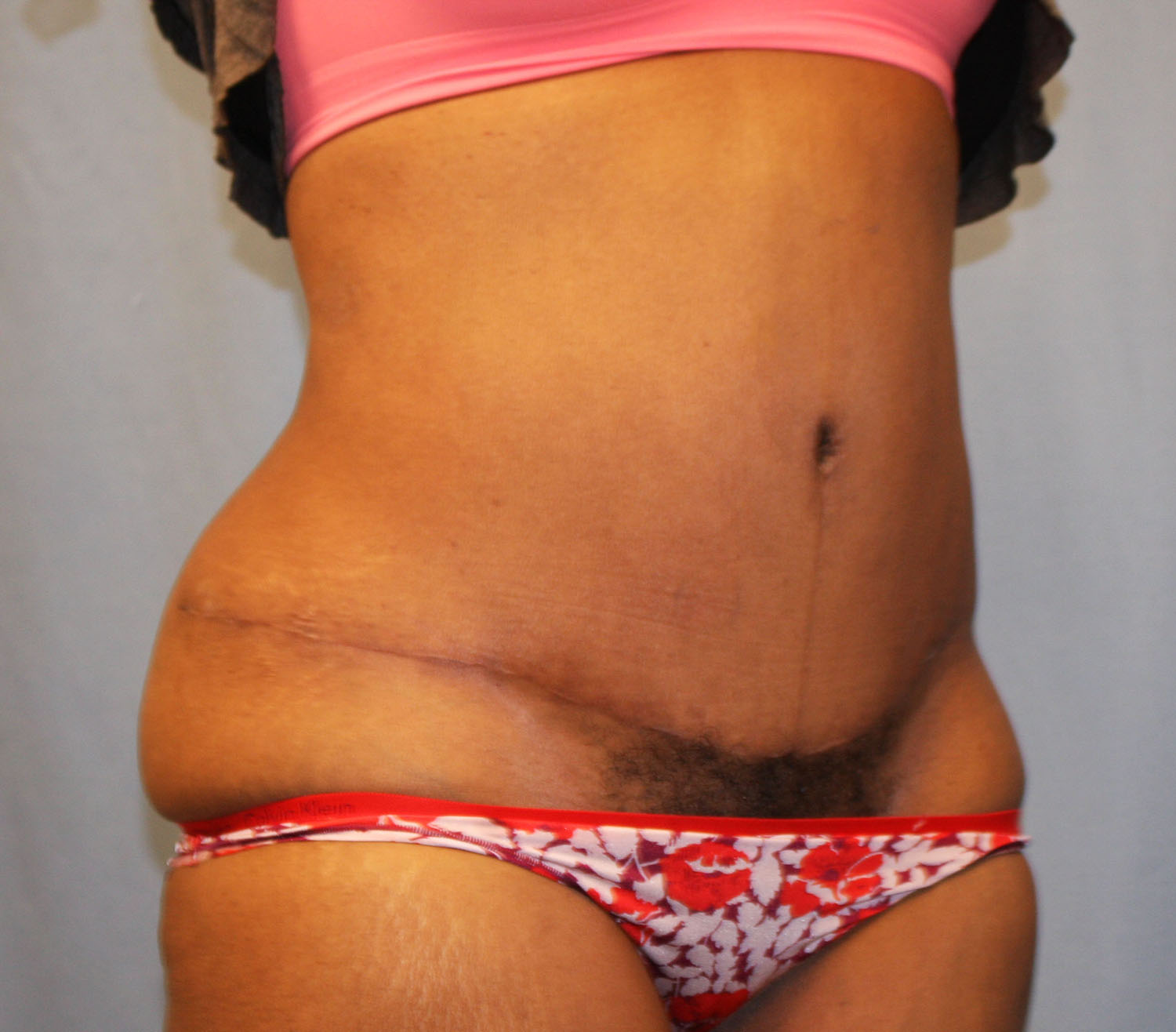 After Image: Tummy Tuck - right-front-oblique