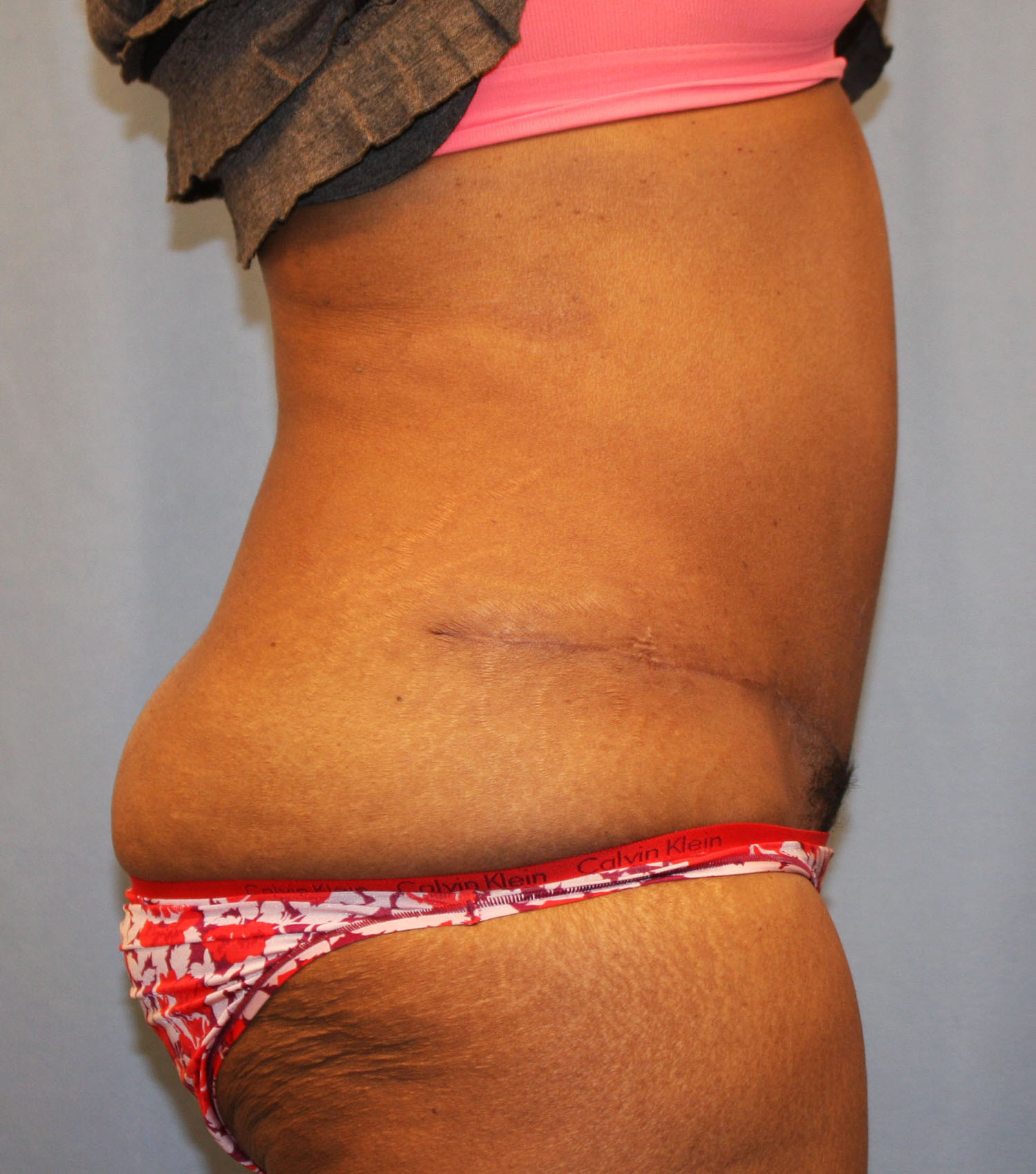 After Image: Tummy Tuck - right-side