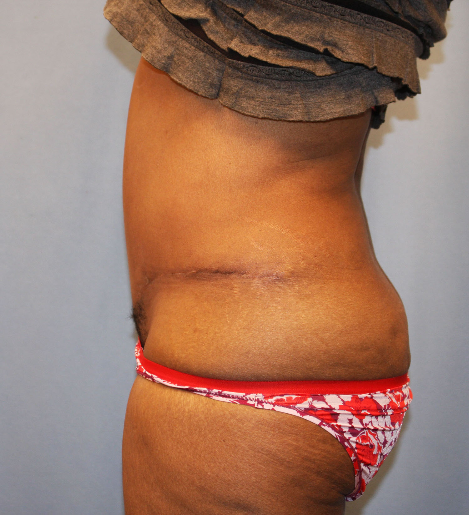 After Image: Tummy Tuck - left-side