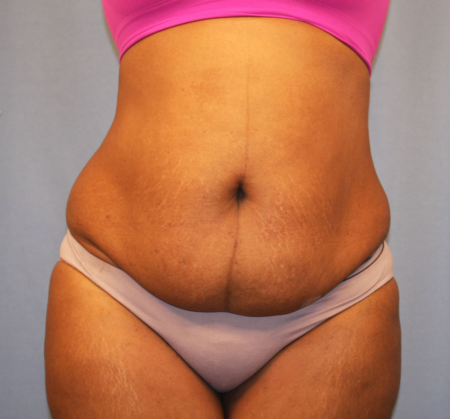 Before Image: Tummy Tuck - front