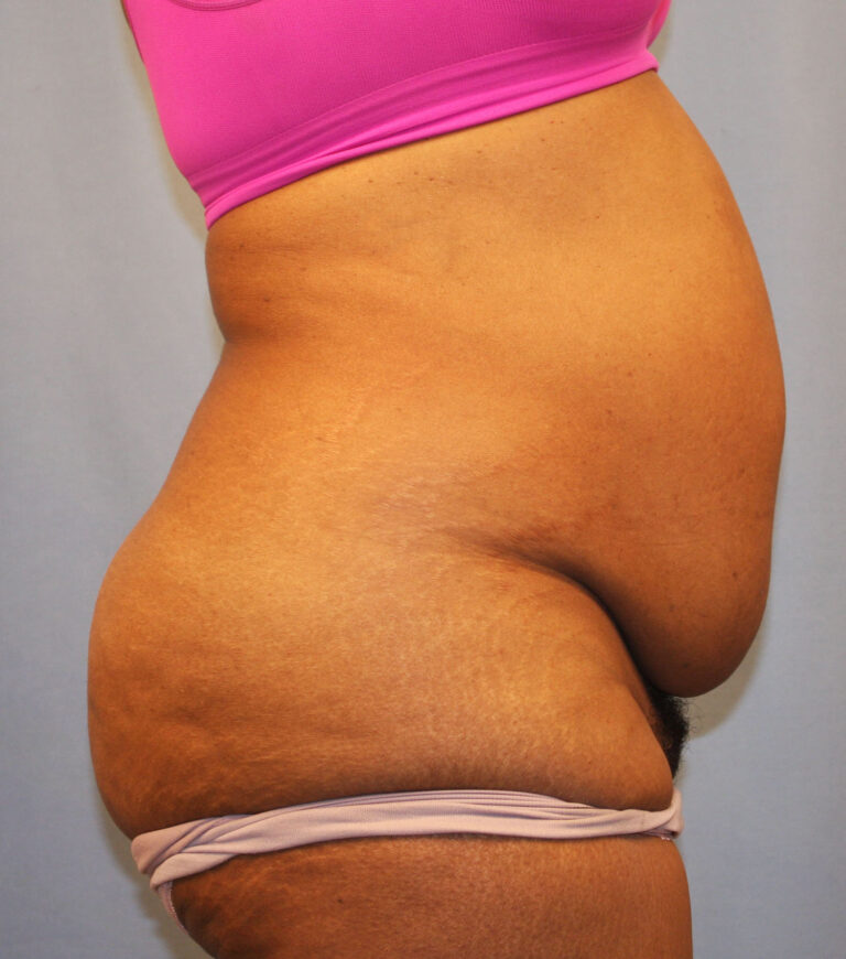 Before Image: Tummy Tuck - right-side