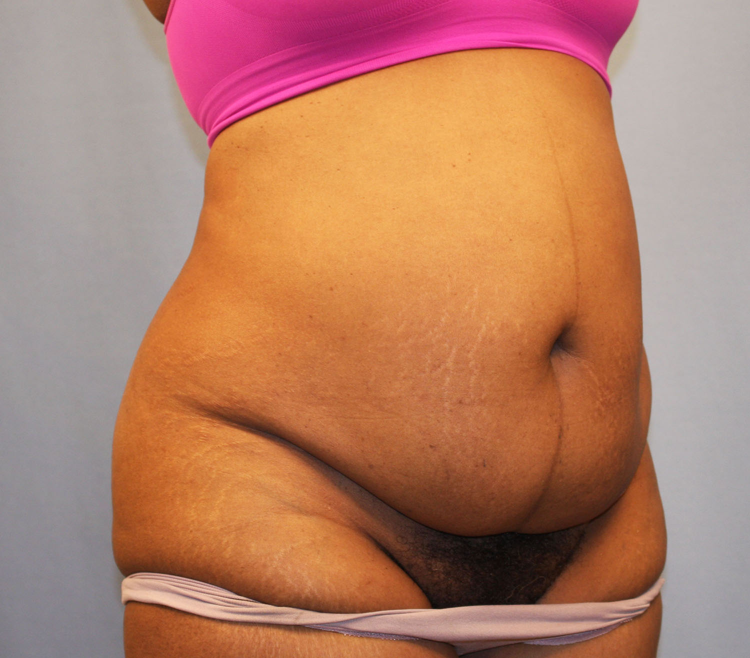 Before Image: Tummy Tuck - right-front-oblique