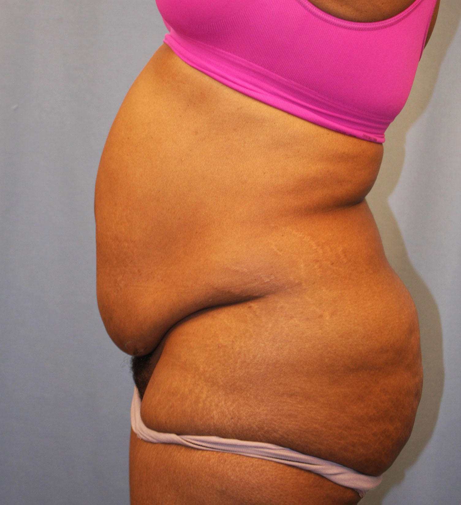 Before Image: Tummy Tuck - left-side