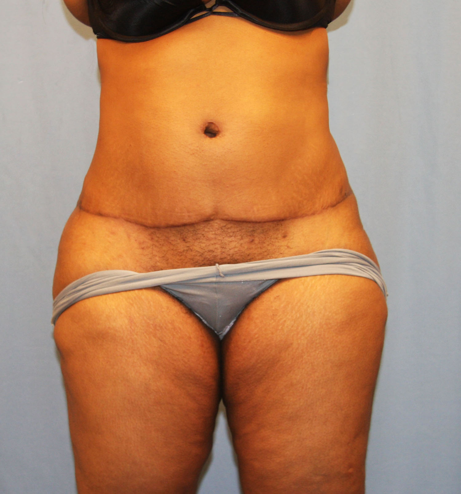 After Image: Tummy Tuck - front