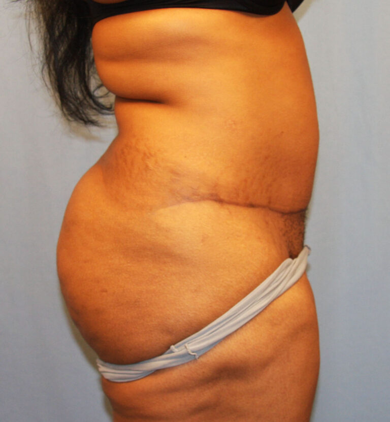 After Image: Tummy Tuck - right-side