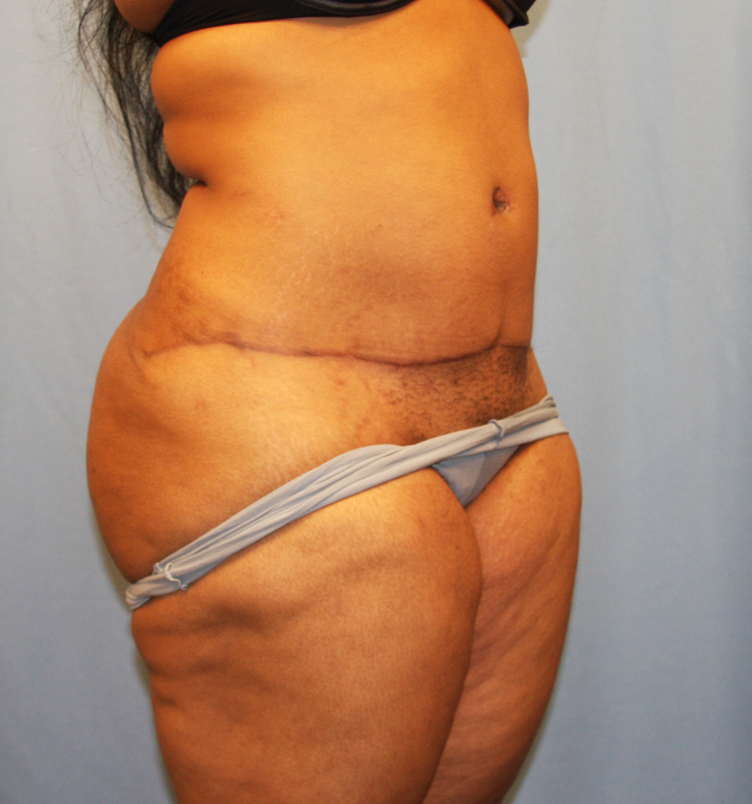 After Image: Tummy Tuck - right-front-oblique