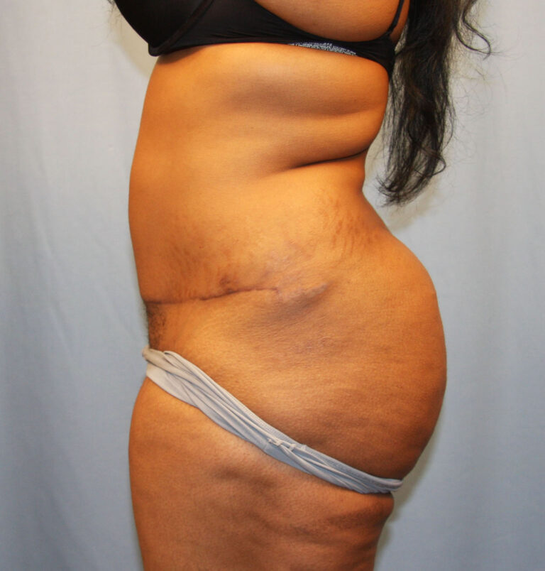 After Image: Tummy Tuck - left-side