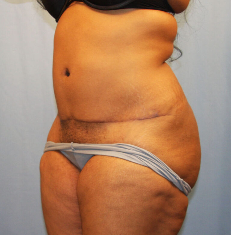 After Image: Tummy Tuck - left-front-oblique