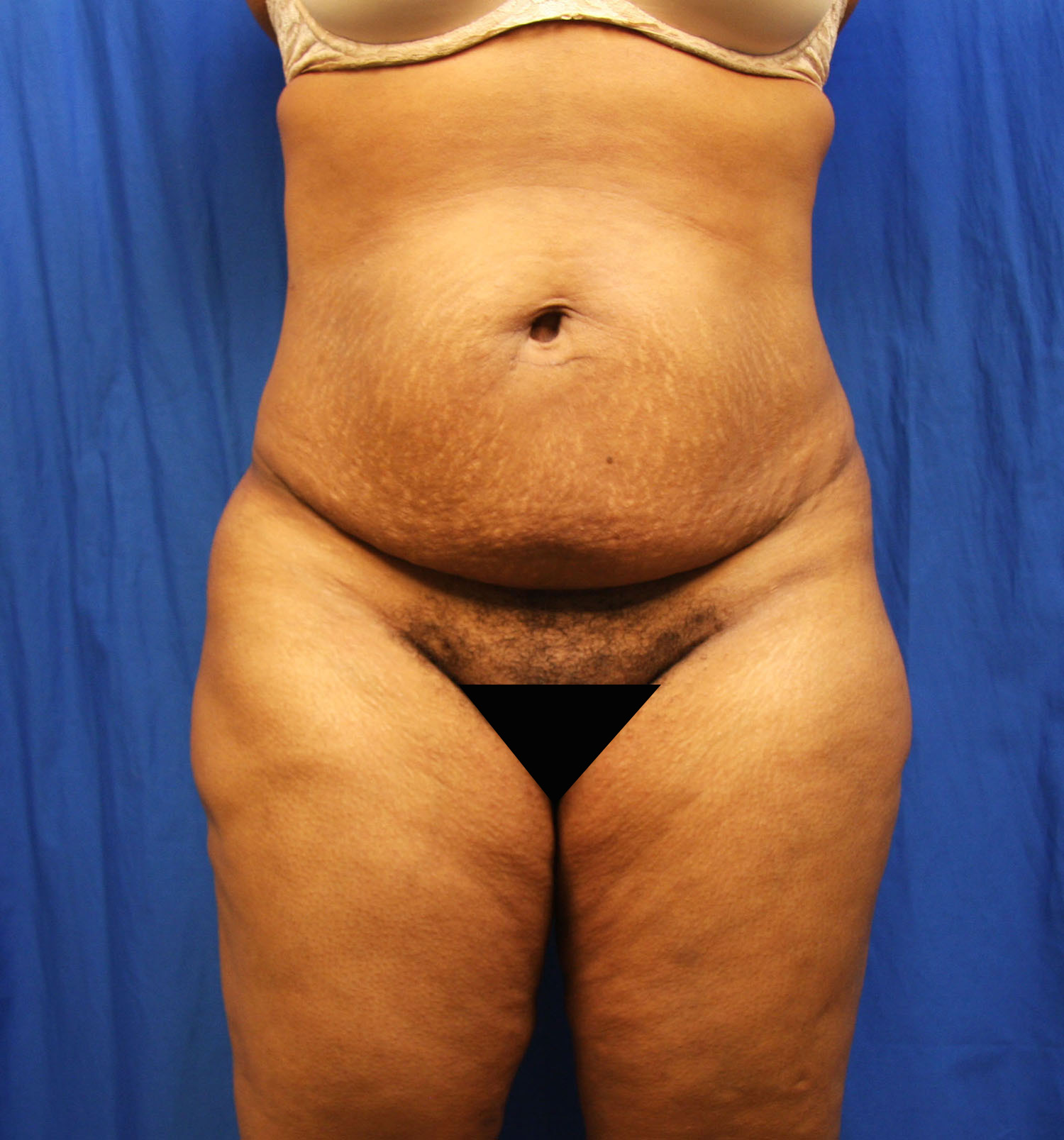 Before Image: Tummy Tuck - front