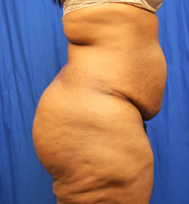 Before Image: Tummy Tuck - right-side