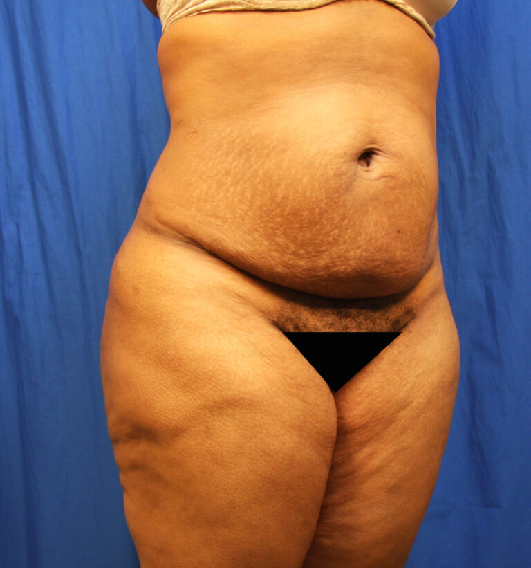 Before Image: Tummy Tuck - right-front-oblique