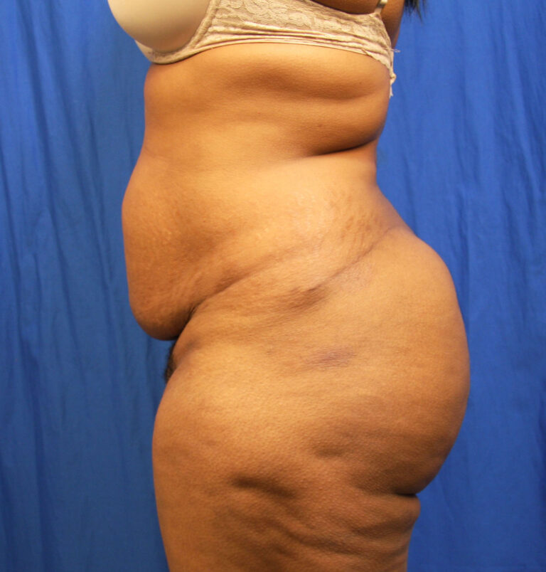 Before Image: Tummy Tuck - left-side