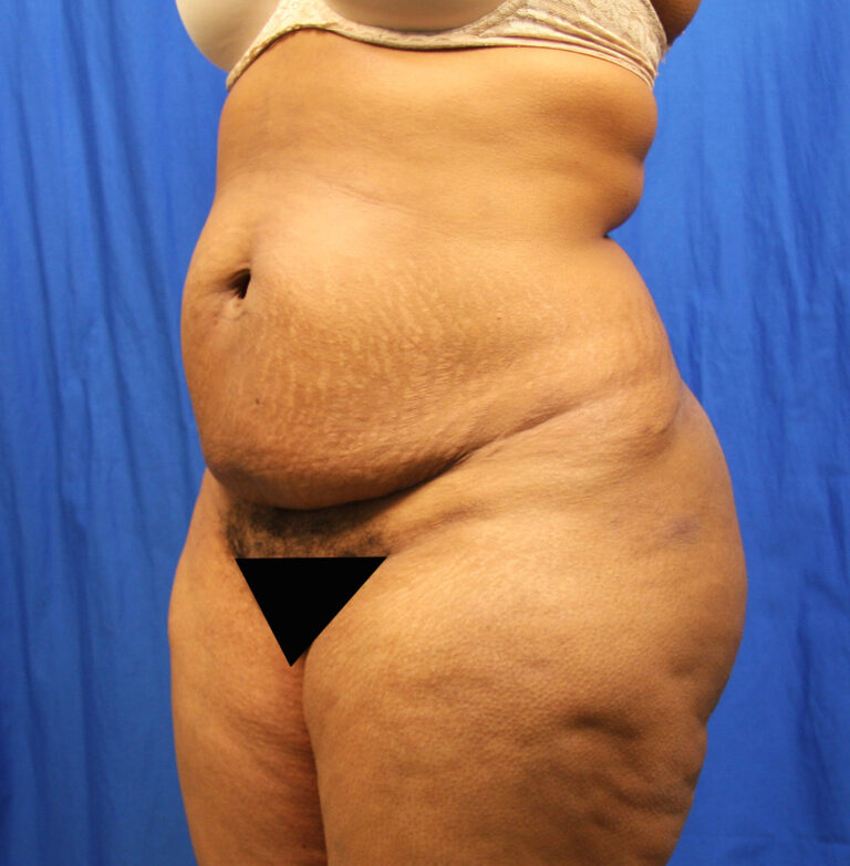 Before Image: Tummy Tuck - left-front-oblique