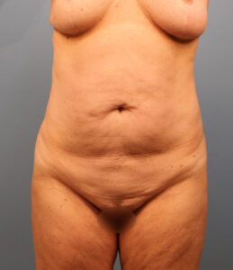 Before Image: Tummy Tuck