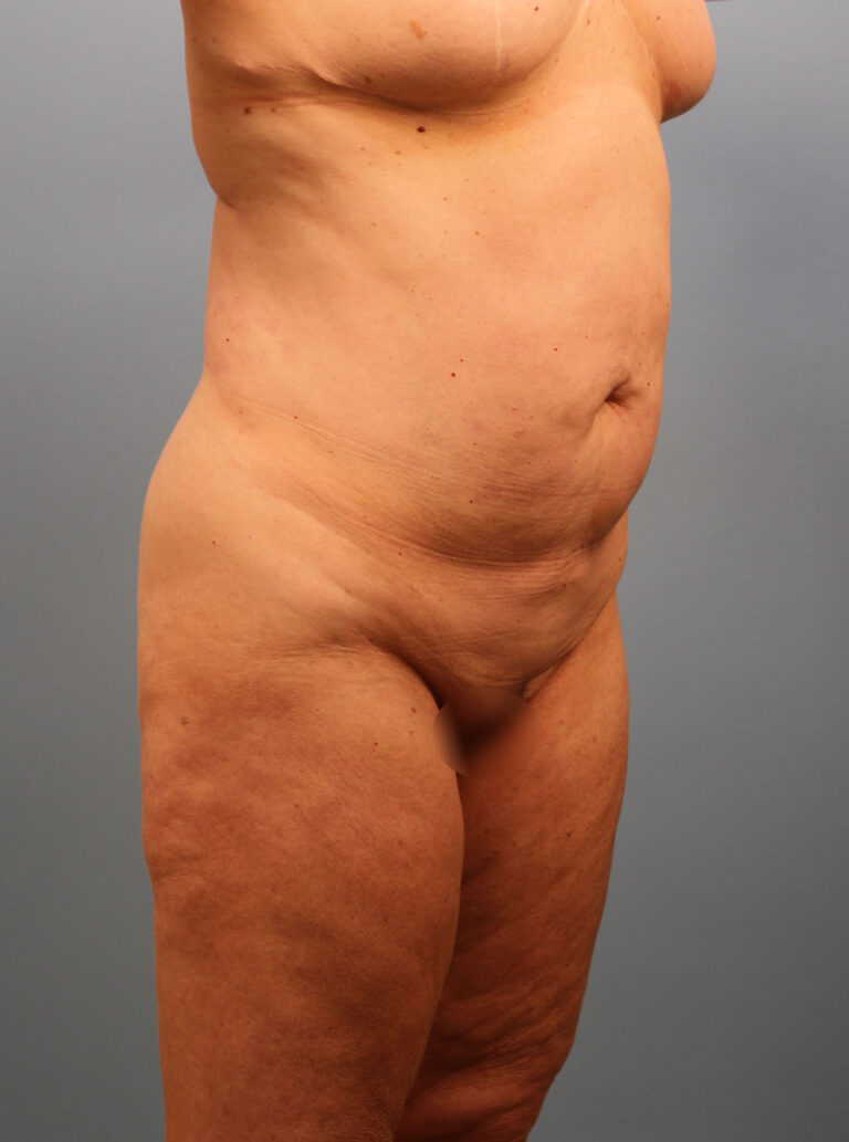 Before Image: Tummy Tuck - right-front-oblique