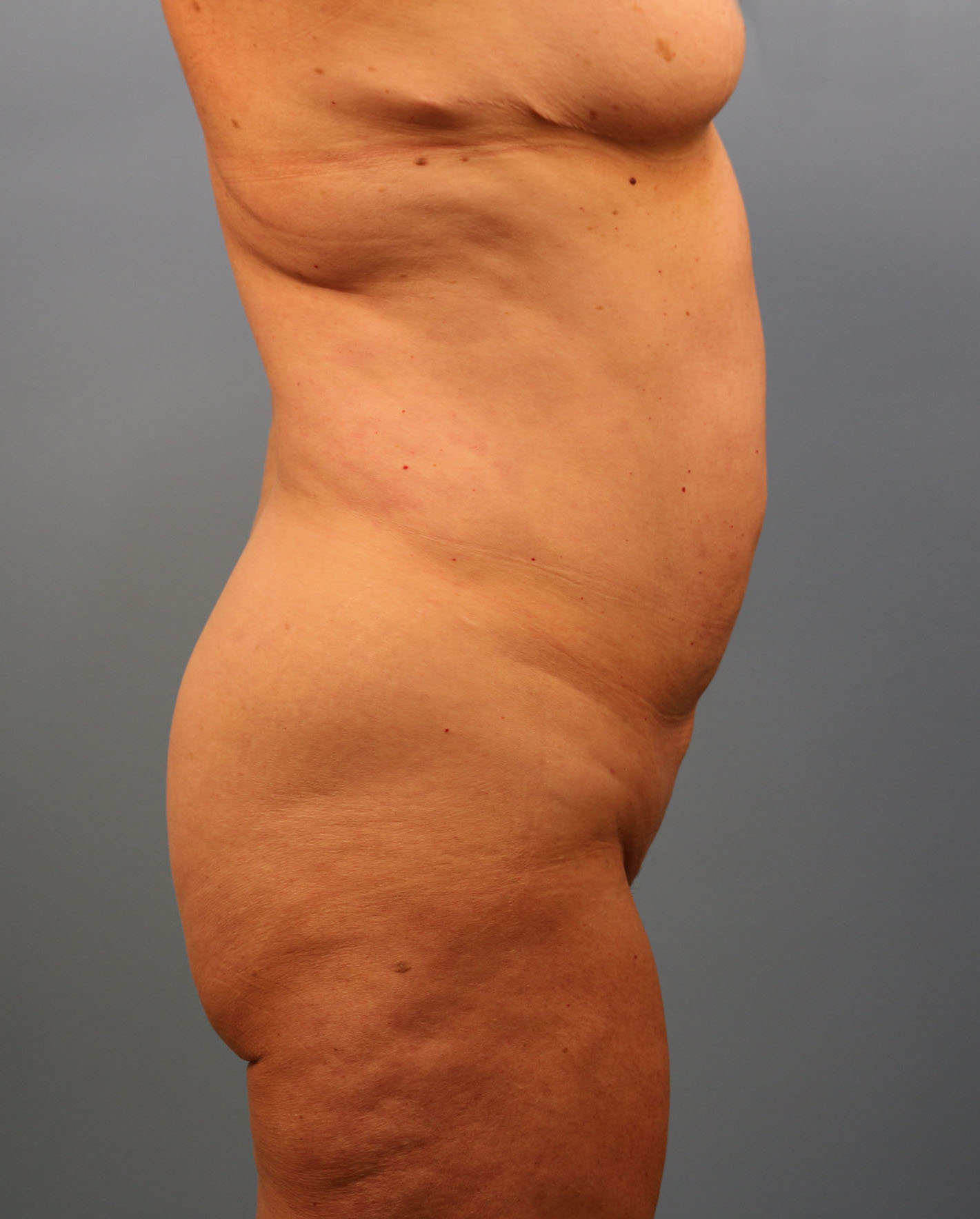 Before Image: Tummy Tuck - right-side