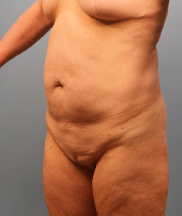 Before Image: Tummy Tuck - left-front-oblique