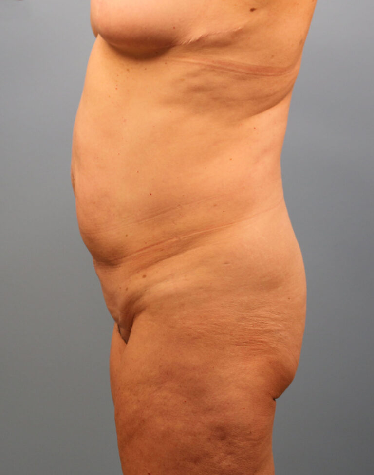 Before Image: Tummy Tuck - left-side
