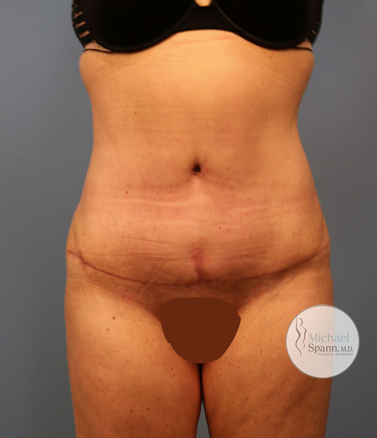 After Image: Tummy Tuck - front
