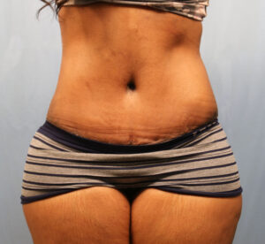 After Image: Tummy Tuck