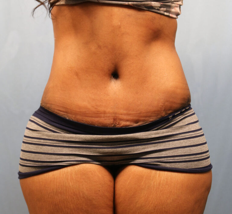 After Image: Tummy Tuck - front