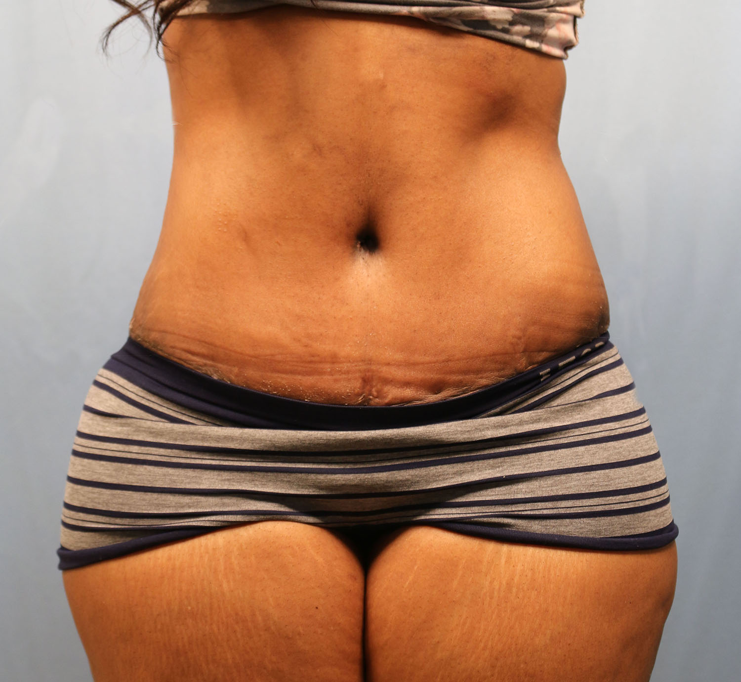 After Image: Tummy Tuck - front