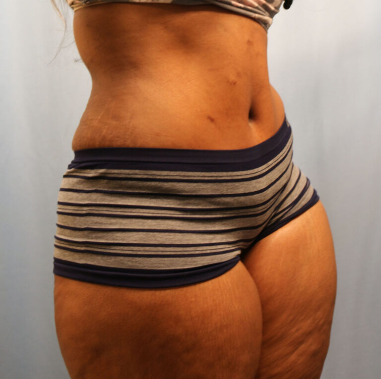 After Image: Tummy Tuck - right-front-oblique