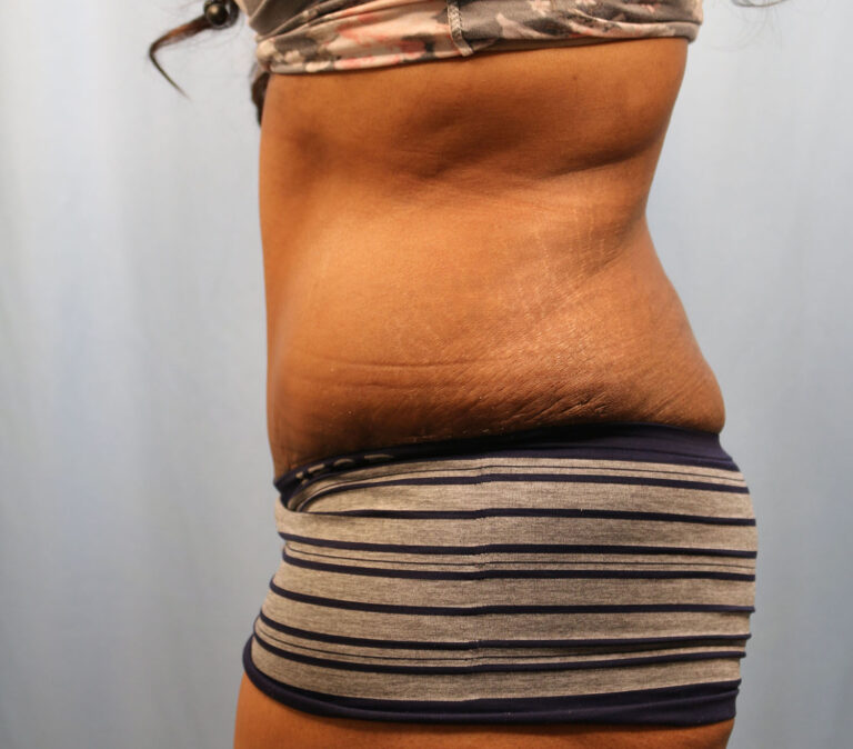 After Image: Tummy Tuck - left-side