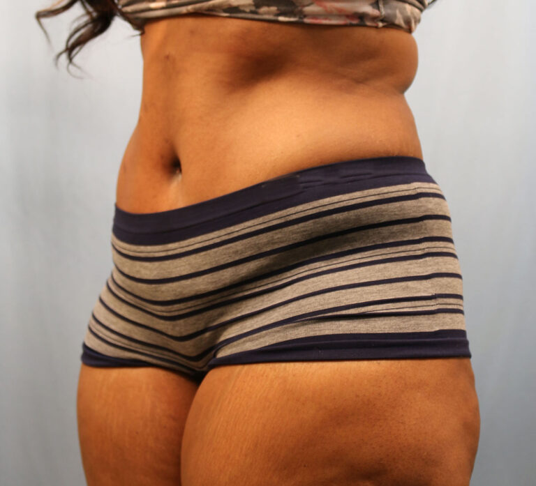 After Image: Tummy Tuck - left-front-oblique