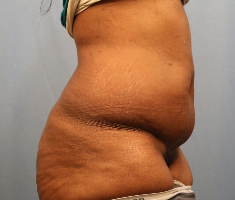 Before Image: Tummy Tuck - right-side