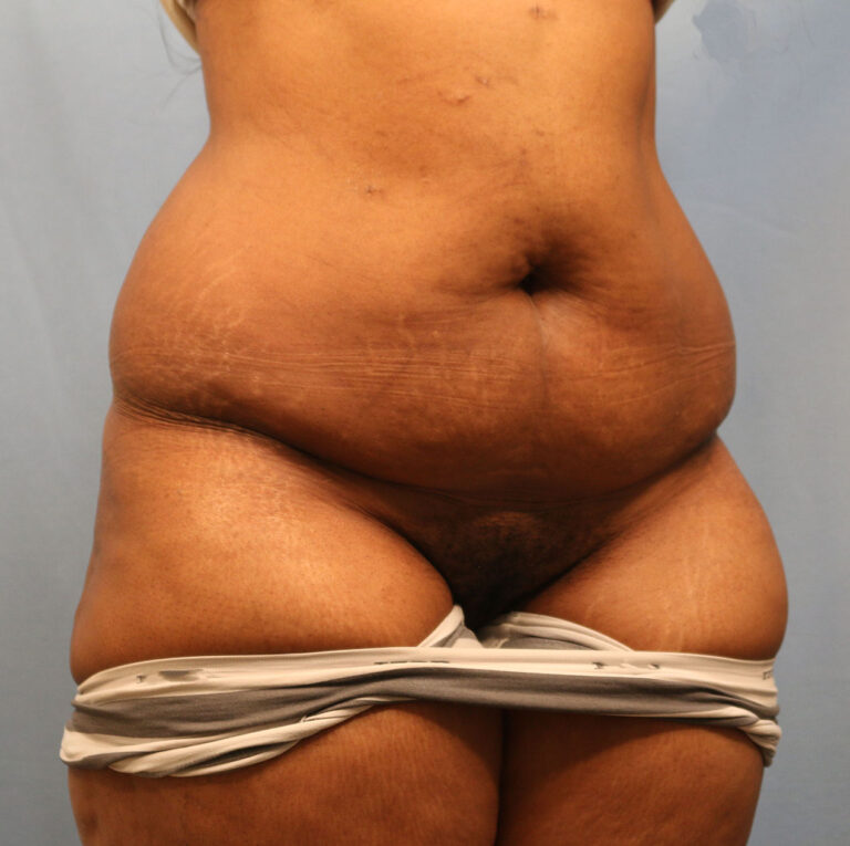 Before Image: Tummy Tuck - right-front-oblique
