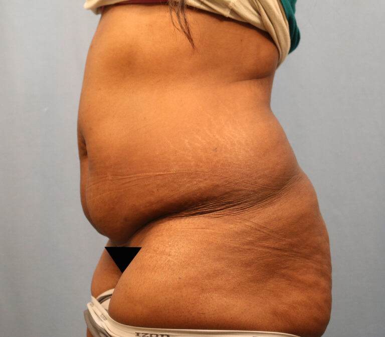 Before Image: Tummy Tuck - left-side