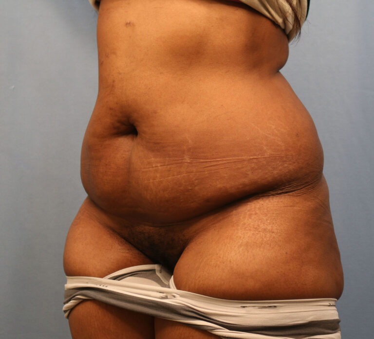 Before Image: Tummy Tuck - left-front-oblique